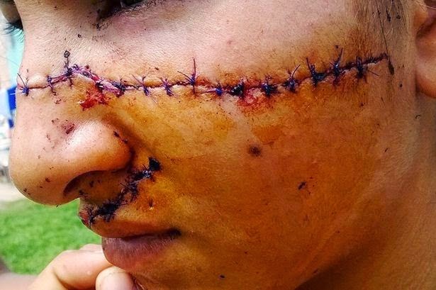 Gadis Diserang Menggunakan Pisau kerana Terlalu Cantik 