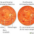 Google algoritmo de alta precisión en la identificación de las enfermedades oculares diabéticas