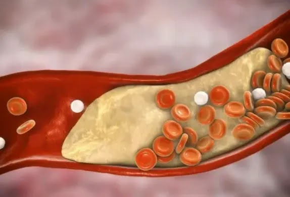 Cholesterol: What Are The Risk Factors Cholesterol: What Are The Risk Factors