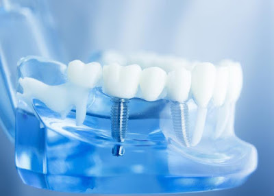 Có nên trồng răng cấm không với cầu răng sứ? 2
