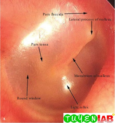 Normal right tympanic membrane with comparison using