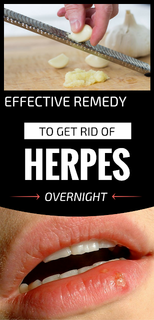Keep Herpes under Control Naturally