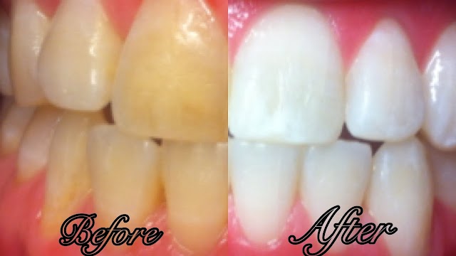 How to make your teeth white fast ?