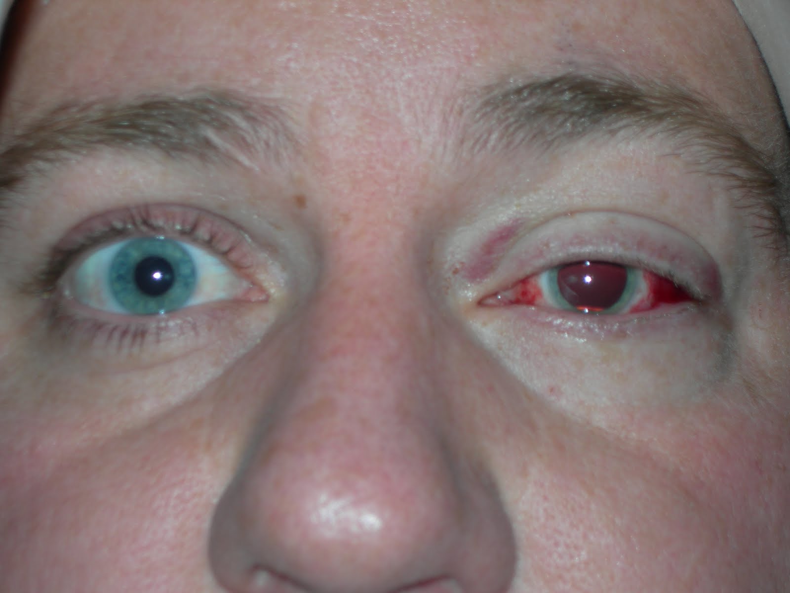 Displaying 18&gt; Images For - Retinal Detachment Symptoms