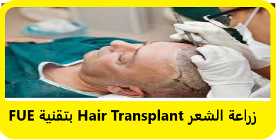 زراعة الشعر Hair Transplant بتقنية FUE