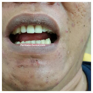 foto, gambar, gigi depan keropos Permata Dental Bali| sebelum dan sesudah gigi keropos diperbaiki di Permata Dental Bali | foto gigi keropos hitam Permata Dental Bali |gigi keropos karena sakit | gigi keropos berlubang | gigi keropos depan| gigi keropos bagian belakang | foto gigi keropos yang sudah diperbaiki Permata Dental Bali |  gigi keropos bagian depan| foto gigi keropos dan patah, foto gigi keropos oleh Permata Dental Bali, Bali Hits, Bali banget, area Bali, Bali kota, area kampus bali. veneer gigi keropos  Bali | veneer gigi keropos badung | veneer gigi keropos nusadua | veneer gigi keropos ngurahrai| veneer gigi keropos denpasar | veneer gigi kropos denpasar kota | veneer gigi keropos Bali | veneer gigi keropos gatsu | |veneer gigi keropos|  depan | veneer gigi keropos  atas | veneer gigi keropos  bawah | veneer gigi keropos  belakang |veneer gigi berlubang bali| veneer gigi berlubang Bali | veneer gigi berlubang nusadua| veneer gigi berlubang ngurahrai| veneer gigi berlubang Badung | veneer gigi berlubang depasar kota | veneer gigi berlubang denpasar| veneer gigi berlubang gatsu| veneer gigi berlubang jimbaran| veneer gigi berlubang bagus Permata Dental Bali | veneer gigi berlubang baik di Permata Dental Bali | veneer gigi berlubang cepat di Permata Dental Bali | veneer gigi berlubang murah di Permata Dental Bali | veneer gigi berlubang aman | veneer gigi berlubang mudah di Permata Dental Bali | veneer gigi berlubang promo Permata Dental Bali | gambar veneer gigi berlubang Permata Dental Bali | gambar sebelum dan sesudah veneer gigi hitam dan berlubang  veneer gigi hitam Bali | veneer gigi hitam Bali | veneer gigi hitam denpasar | veneer gigi hitam jimbaran | veneer gigi hitam nusadua | veneer gigi hitam Bali kota | veneer gigi hitam ngurahrai| veneer gigi hitam badung | veneer gigi hitam gatsu | veneer gigi hitam bagus | veneer gigi hitam baik | veneer gigi hitam cepat di Permata Dental Bali | veneer gigi hitam murah di Permata Dental Bali | veneer gigi hitam aman | veneer gigi hitam mudah di Permata Dental Bali | veneer gigi hitam promo Permata Dental Bali | gambar veneer gigi hitam Permata Dental Bali | gambar sebelum dan sesudah veneer gigi hitam dan berlubang Permata Dental