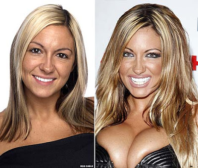 Celebrity Breasts on Jobs And Cheek Implants   Celebrity Plastic Surgery Before And After