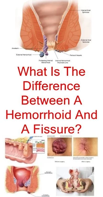 Difference Between Anal Fissures And Haemorrhoids