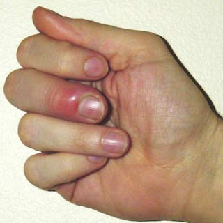 picture of paronychia by picking at a hangnail