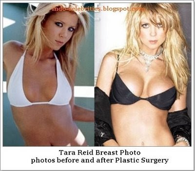 tara reid plastic surgery pictures