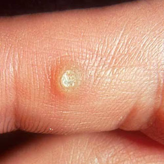 How To Remove A Wart - FitnessHealthSpace.blogspot.com