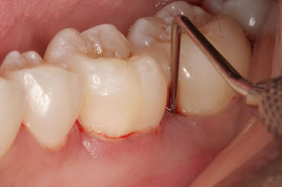 Viêm lợi có mủ có ảnh hưởng đến răng không?-1