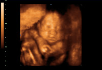 3d Ultra Sound3