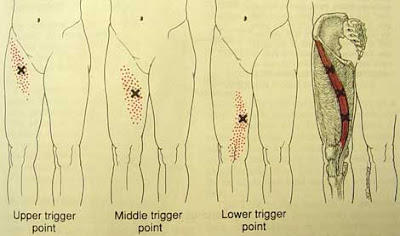 MIOTERAPIA