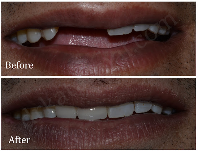 Fractured Carious Teeth Treated with Post and core and Zirconia Crown