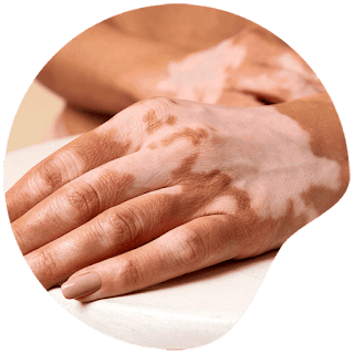 Homeopathic medicines for vitiligo