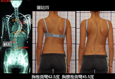 脊椎側彎運動, 脊椎側彎治療, 脊椎側彎矯正, 脊椎側彎