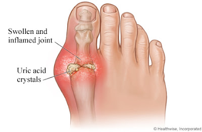 Hasil gambar untuk gout arthritis