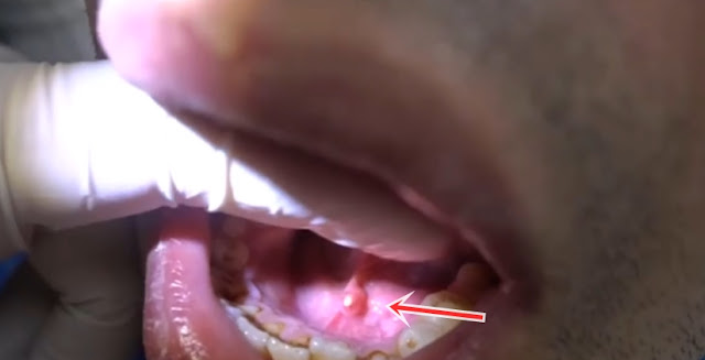 Transoral Removal of Submandibular Stone - Removal of Salivary Gland Stone - Intraoral Removal of Stone in The Proximal Submandibular Duct - Removing A Stone From A Salivary Duct - Wharton's Duct Sialolith Removal