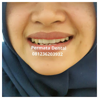 gambar foto contoh sebelum dan sesudah veneer gigi kelinci buatan manis cantik bali jember banyuwangi murah berkualitas di PERMATA DENTAL gambar gigi rusak yang di veneer gigi yang tidak rapi gigi renggang gigi patah cuil rompal pendek karies hitam kuning