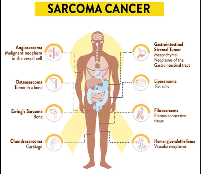 Know what is soft tissue cancer and identify with which symptoms?