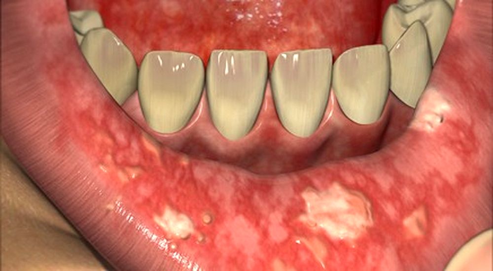 Oral Mucositis