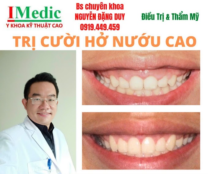 Trị cười hở nướu Cà mau thẩm mỹ nướu cao cười lộ nướu nhiều gây mất thẩm mỹ nụ cười Mỹ Viện Nano Phòng khám chuyên khoa Kỹ thuật cao IMedic Y Khoa Kỹ Thuật Cao Phẫu thuật Hàm Mặt thẩm mỹ Bs chuyên khoa NGUYỄN ĐẶNG DUY 091 944 94 59 