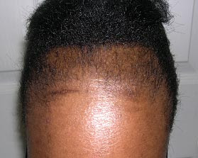 Traction Alopecia