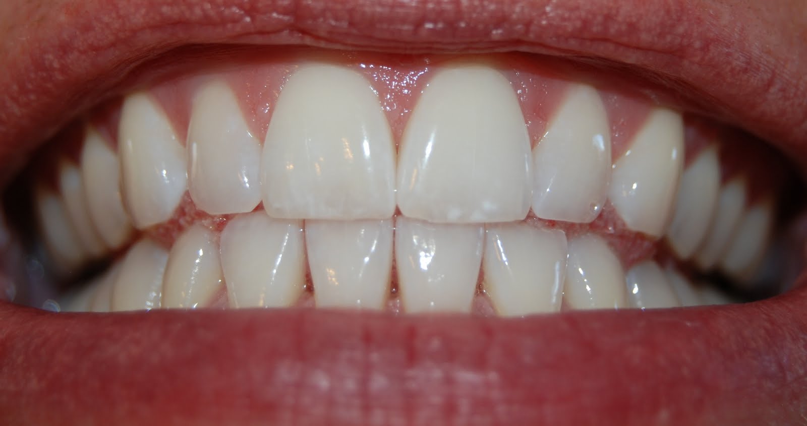 Just whiten my teeth they hurt