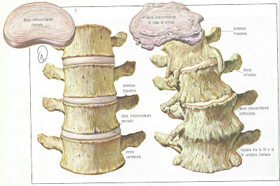 Il disco intersomatico artrosico della colonna lombare