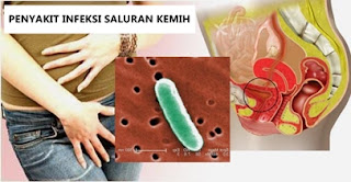 Nama obat untuk penyakit sipilis di apotik ampuh