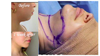 chin liposuction before and after