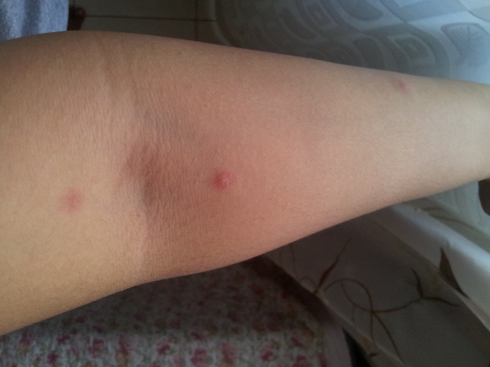 Ubat Tahan Gatal Chicken Pox - Descar 0