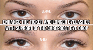 Careprost eye drops