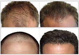 FUE hair transplant in Islamabad