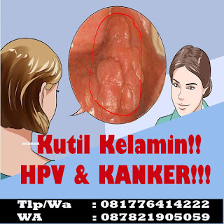 Obat Kutil Kelamin