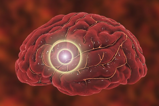 Enfermedad cerebrovascular isquemica