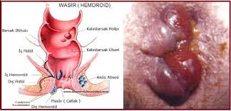 Obat Alami Wasir Eksternal