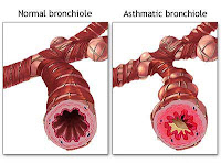 Asthma