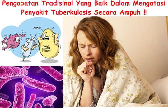Obat Tradisional Tuberkulosis Ekstrak Alami Pilihan