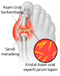 Penyebab Asam Urat & Obat Asam Urat Alami, Ampuh Mengobati Asam Urat Secara Alami