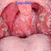 TONSILITIS-This is inflammation of the tonsils.