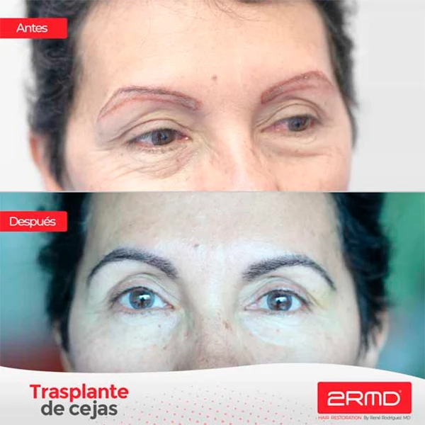 transplante-cejas