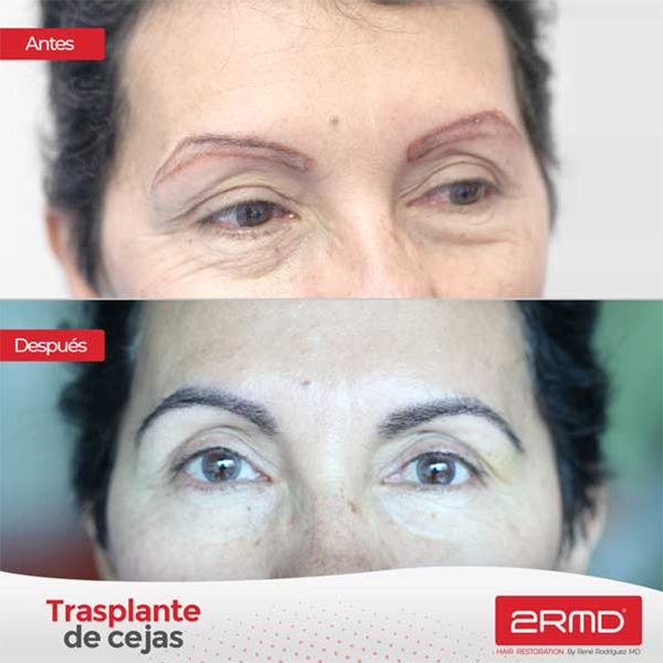 transplante-cejas