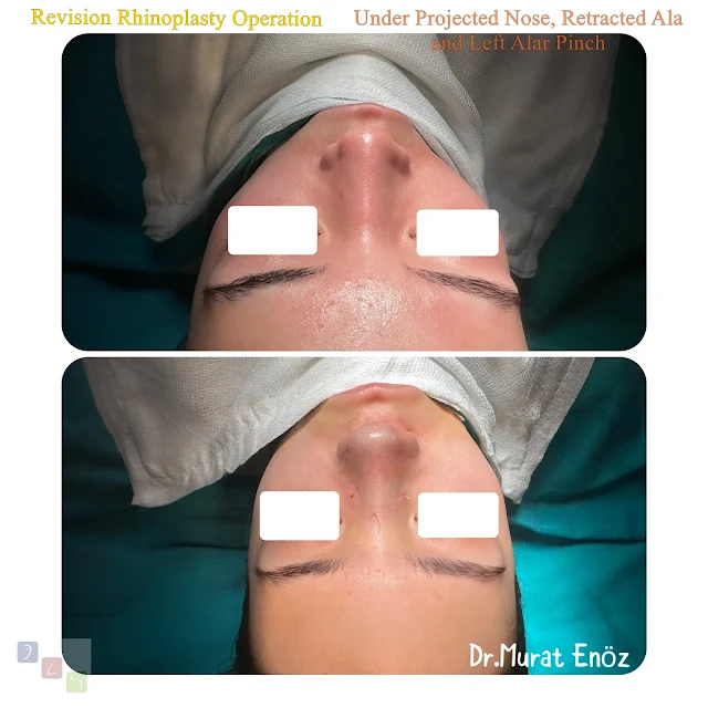 revision rhinoplasty, underprojected nose, retracted ala, alar pinch deformity, secondary nose surgery, nasal tip correction, rhinoplasty complications