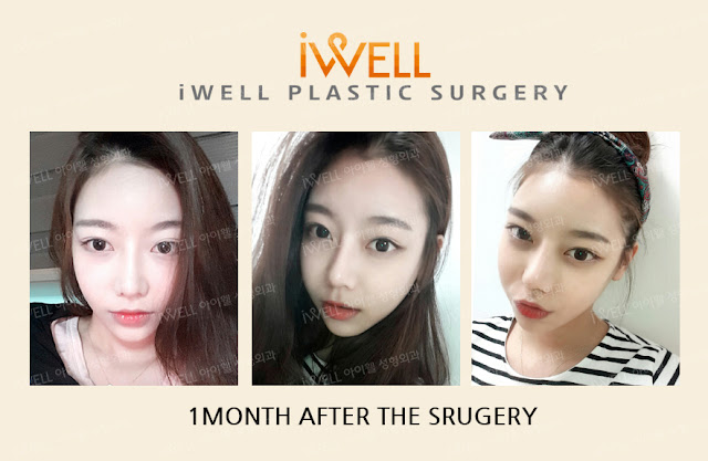 Cheekbone reduction surgery
