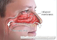 Cara Mudah Menyembuhkan Hidung Mampet