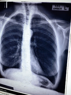 xray chest