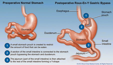 https://www.laparoscopic-general-surgery.com/gastric-bypass/