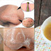 Do You Want Clear Skin Without Blackheads Here Are A Few Steps To Follow—Easy!